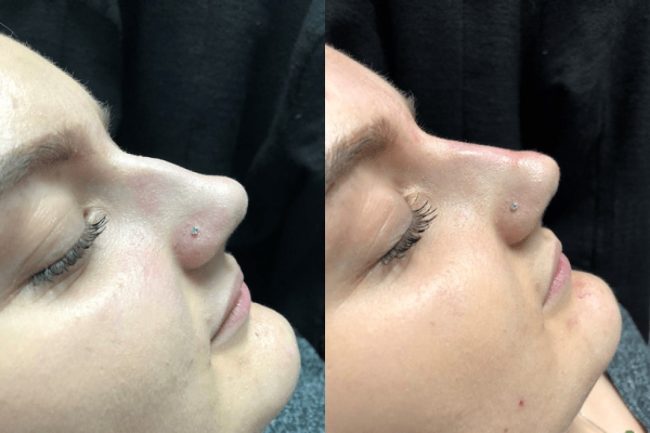 non surgical nose job